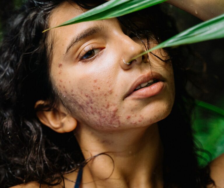 can acne scars go away?